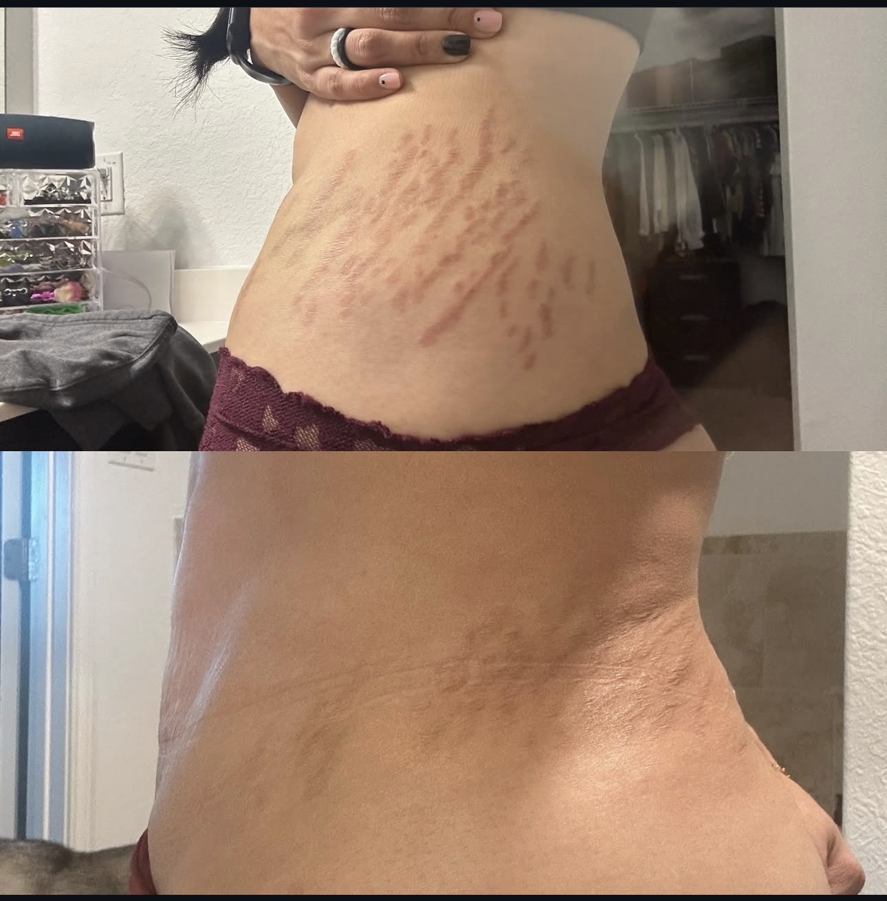 Inkless Stretch Mark Revision